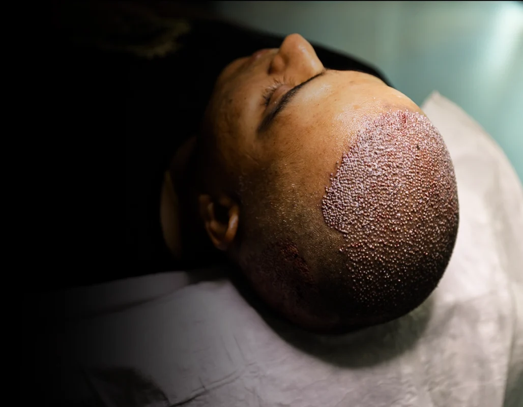 FUE Hair Transplant - FUE Saç Ekimi