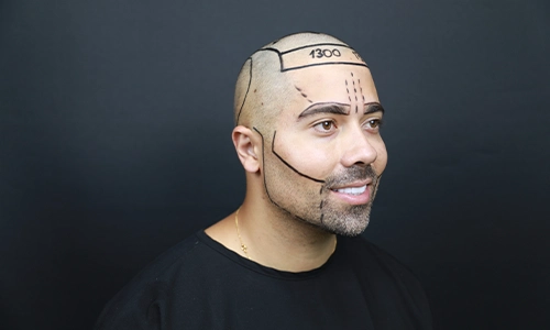 Beard Transplant - Eyebrow Transplant - Sakal Ekimi - Kaş Ekimi