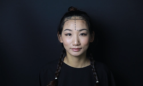Women Hair Transplant