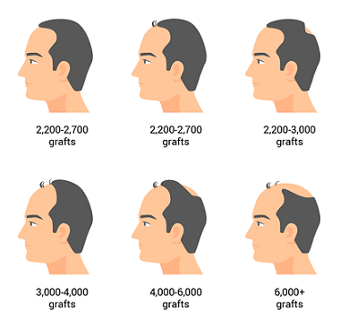 FUE Hair Transplant - FUE Saç Ekimi
