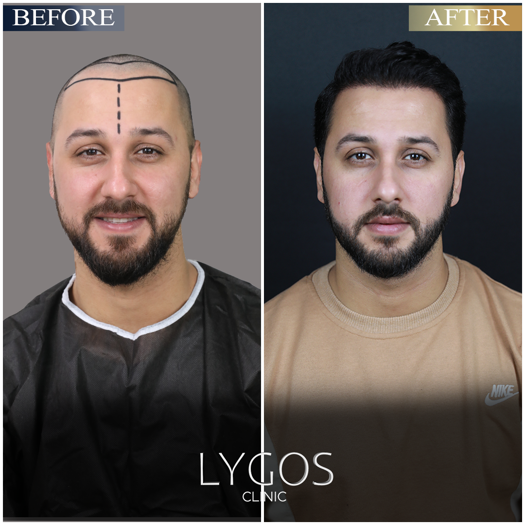 2023 Top 9 Best Hair Transplant Clinics in the USA (Prices + Advice)